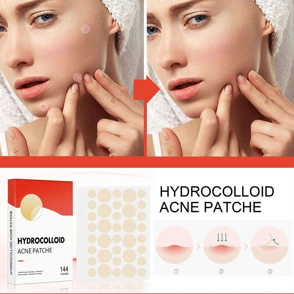 Acne Pimple Patch Set, 144 Hydrocolloid Patches - Image 2