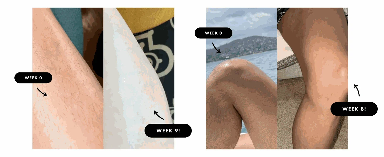 IPL Hair Removal Device with 999,900 Flashes for Full-Body Use - Image 17