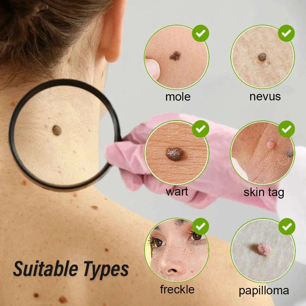 Laser Plasma Pen for Targeted Skin Application - Image 2