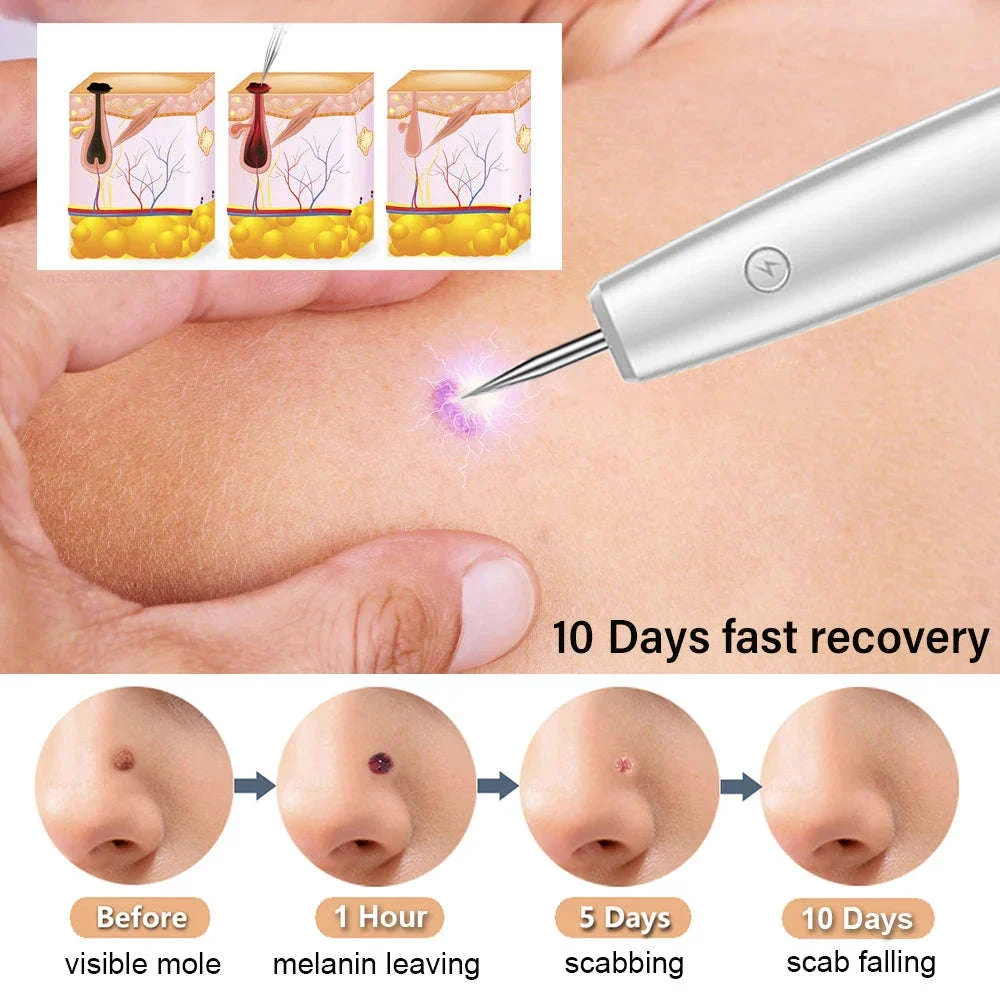 Laser Plasma Pen for Targeted Skin Application - Image 4