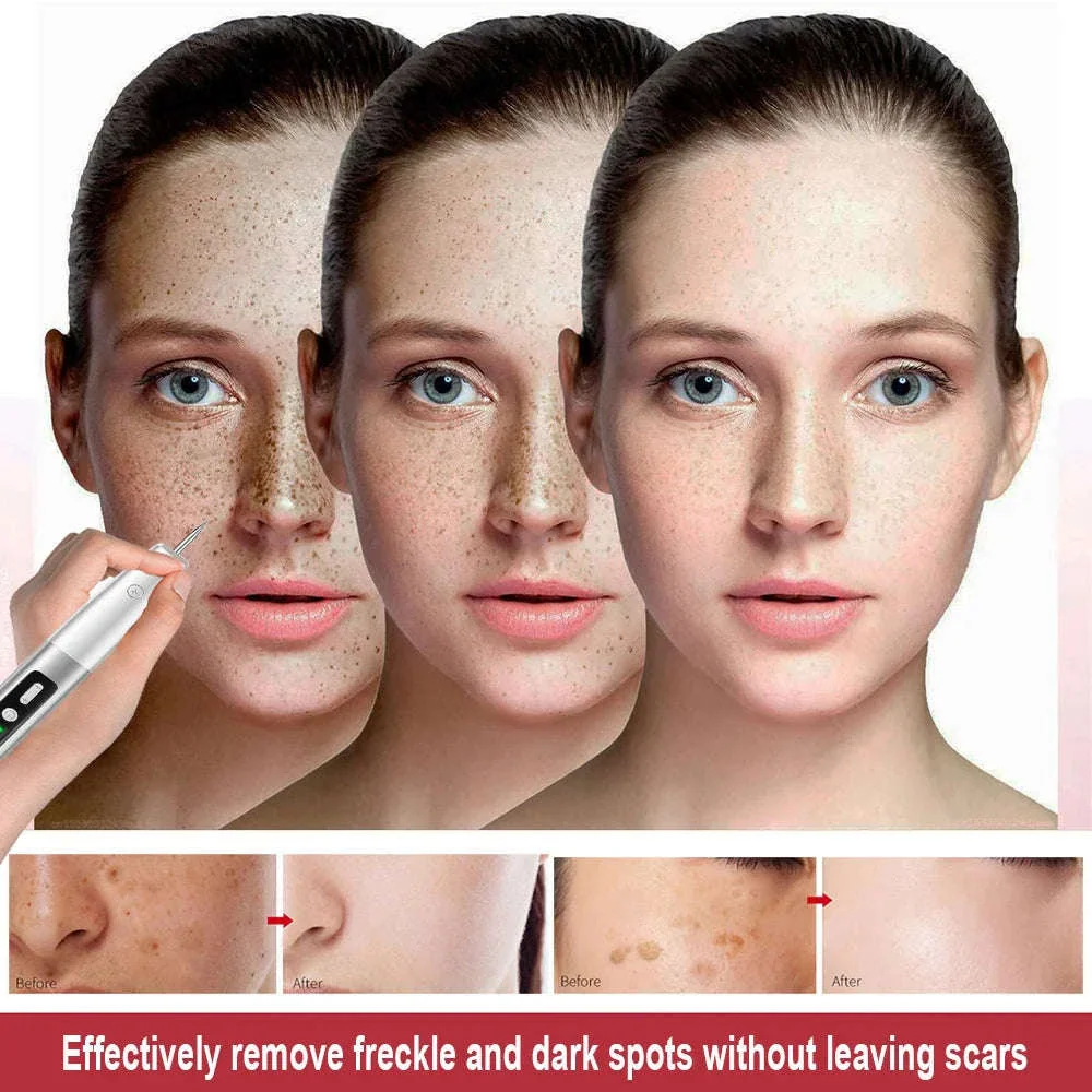 Laser Plasma Pen for Targeted Skin Application - Image 5